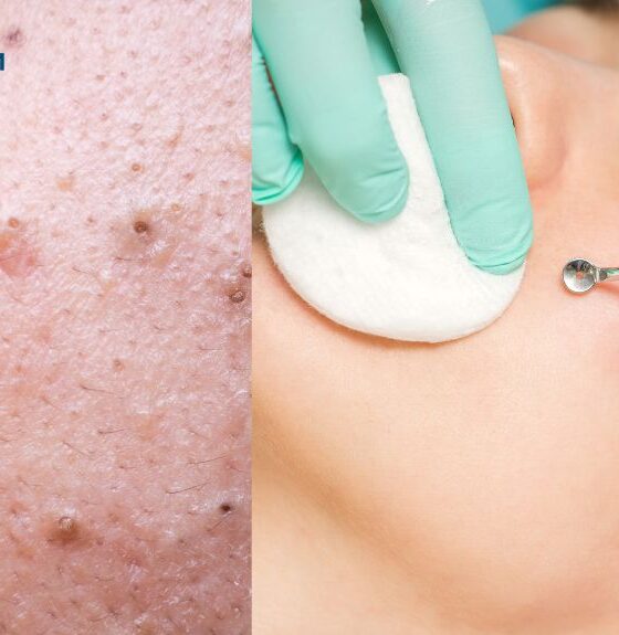 Banishing Blackheads: The Ultimate Guide to Clear Skin