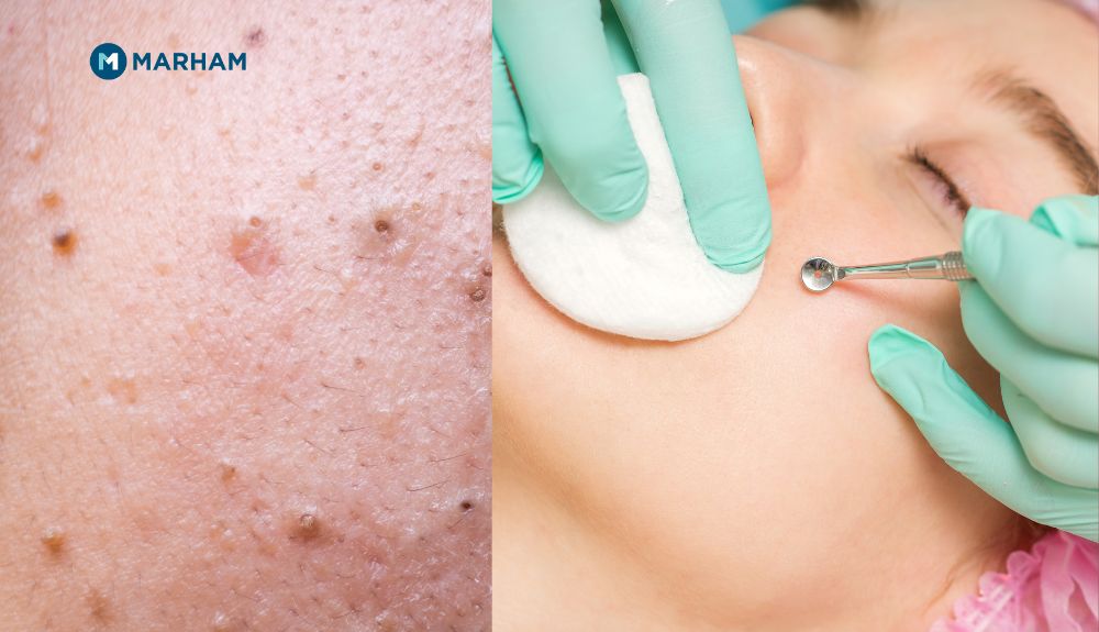 Banishing Blackheads: The Ultimate Guide to Clear Skin