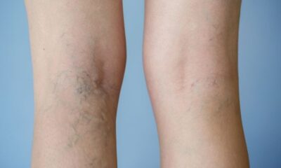 Goodbye Varicose Veins, Hello Smooth Legs: Treatment Options Explained
