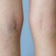 Goodbye Varicose Veins, Hello Smooth Legs: Treatment Options Explained