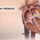 Frequently Asked Questions About Catheter Ablation