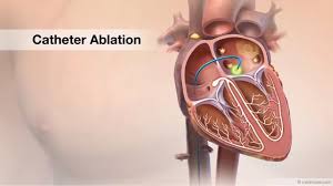 Frequently Asked Questions About Catheter Ablation