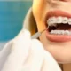 Orthodontic Braces for Adults: A Comprehensive Guide